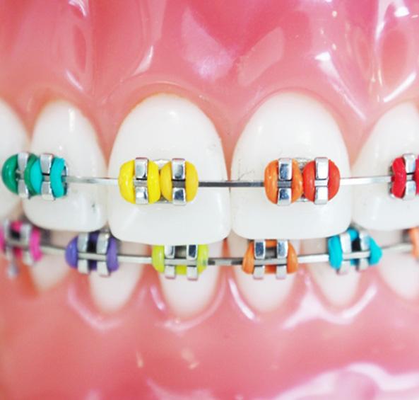 Closeup of a model mouth wearing very colorful traditional braces