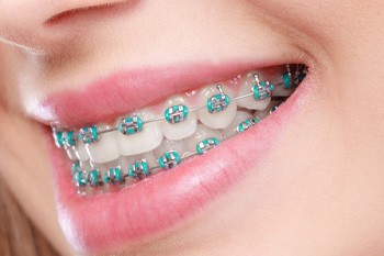 Closeup of female patient wearing traditional metal braces