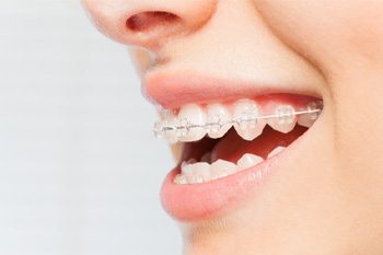 Closeup of a patient wearing nearly invisible clear braces