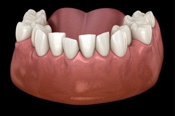 Digital illustration of a lower jaw with crooked teeth