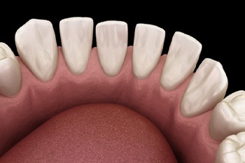 Digital illustration of a lower jaw with gaps between teeth