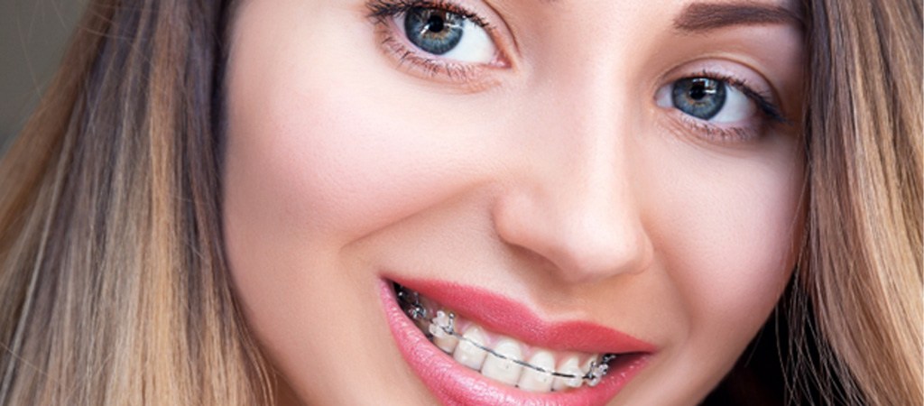 Closeup of young woman wearing clear ceramic braces in Frisco and Prosper