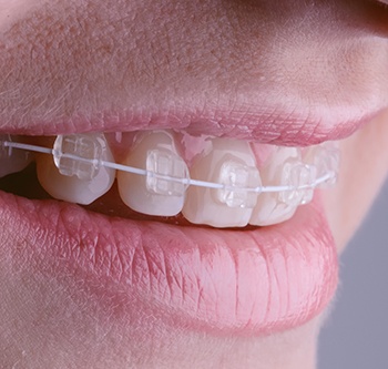 Closeup of clear braces