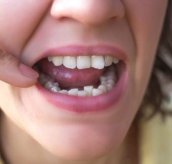 Closeup of crooked teeth