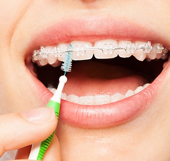 Woman cleaning her braces