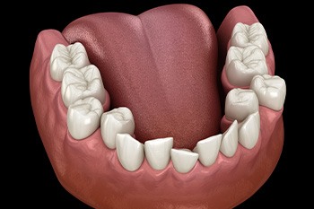 Illustration of crowded teeth