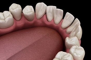 Illustration of gapped teeth