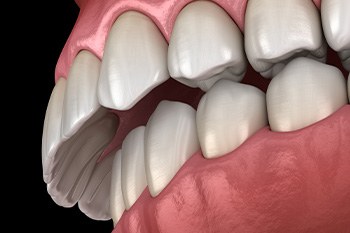 Illustration of overbite