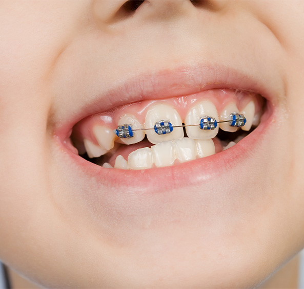 Smiling young boy with braces