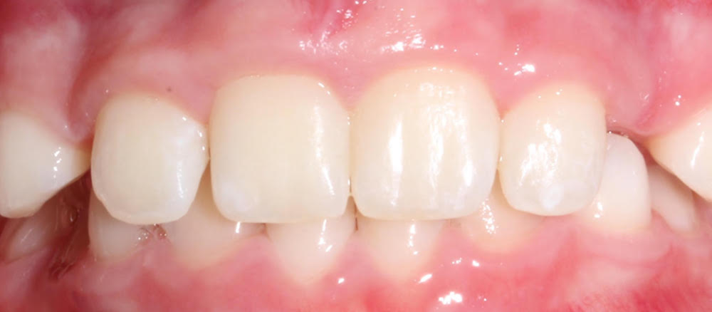 Closeup of flawless smile after treatment