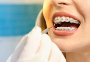 Woman with traditional metal braces