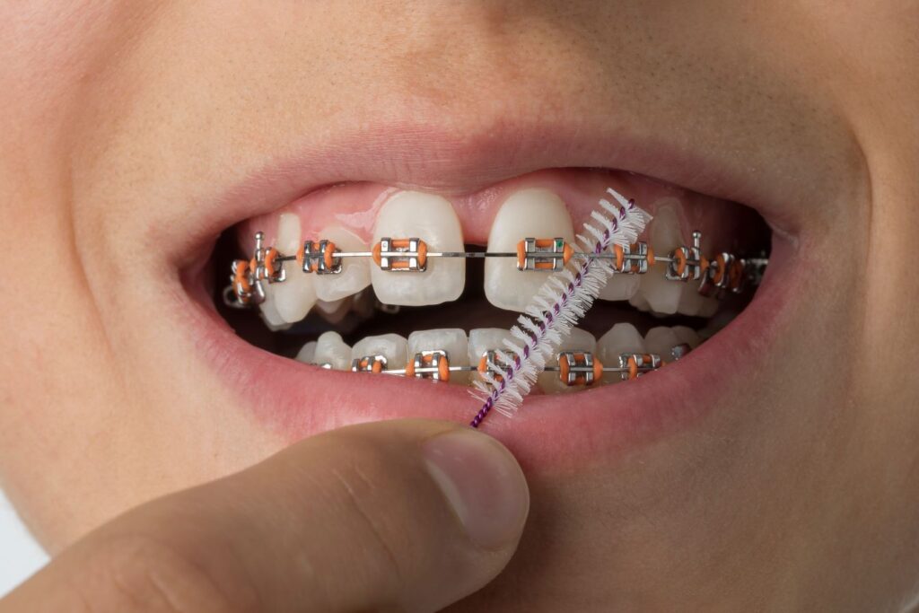 A boy brushing his braces with an interproximal brush.